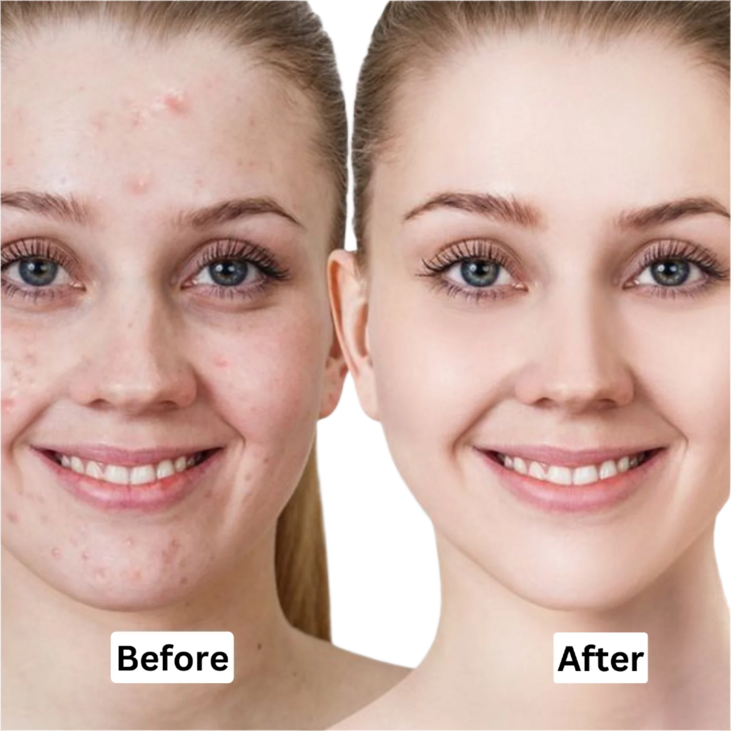 Pure Glow Acne Serum - Acne Treatment & Pore Refining - 30ml